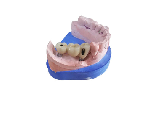 Крона Zirconia CAD CAM зубоврачебная с устоем Zirconia основания титана