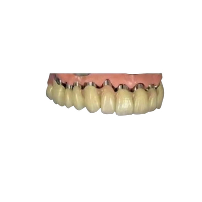 CAD CAM PFM имплантирует крону моста кроны телескопичную зубоврачебное 3D напечатало модели