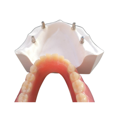 Удобный зубной имплантат Overdenture CAD CAM легкое поддерживает