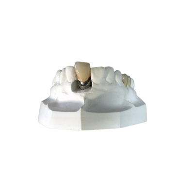 Denture приложения Адвокатуры стабильности изготовленных на заказ локаторов зубного имплантата высокий