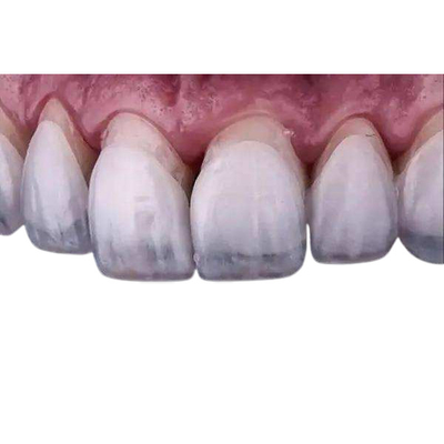 Облицовки кроны Zirconia зубоврачебных Dentures облицовок лаборатории зубоврачебных реставраторские