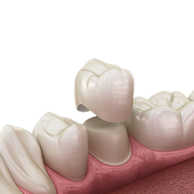 Отказа кроны Zirconia OEM лечить естественного зубоврачебного уникального устойчивый жесткий