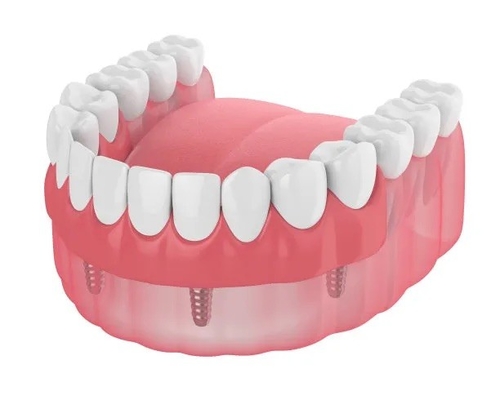 Dentures Missing Teeth Dental Implant Bar Fillings Dentures Temporary Removable Dentures