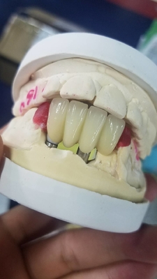 Ровная поверхностная Biocompatible крона зуба Zirconia легкая поддерживает