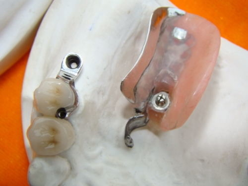 Denture приложения точности зубоврачебной лаборатории продолжительный пятнает устойчивый