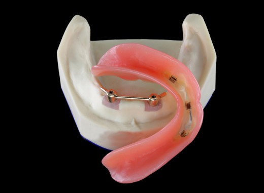 CNC титана All-On-4 имплантирует обеспеченные Dentures для зубоврачебной клиники