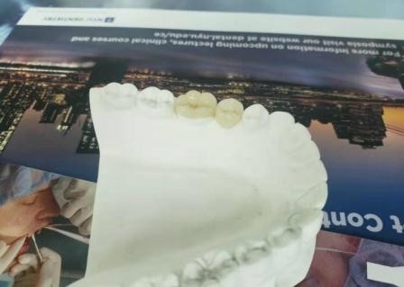 Onlay инкрустации прессы IPS e прочной гибкой кроны моста PFM зубоврачебный максимальный