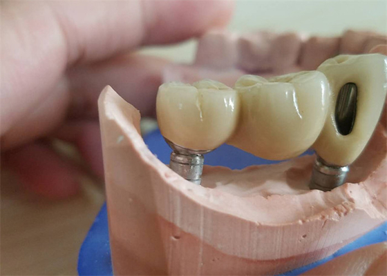 Крона Zirconia CAD CAM зубоврачебная с устоем Zirconia основания титана
