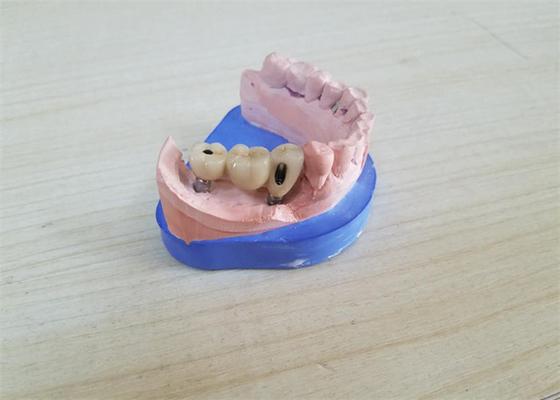 Крона Zirconia CAD CAM зубоврачебная с устоем Zirconia основания титана
