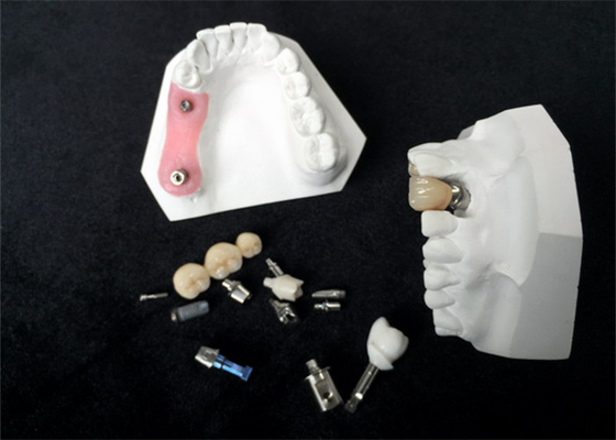 Высокая крона зубного имплантата Zirconia стойкости для зубоврачебного восстановления