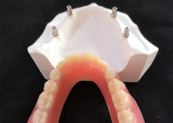Удобный зубной имплантат Overdenture CAD CAM легкое поддерживает