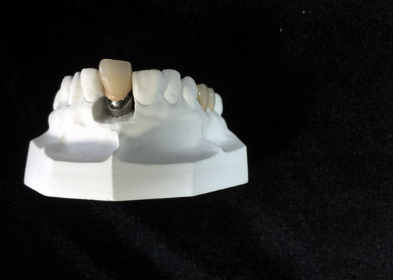 Denture приложения Адвокатуры стабильности изготовленных на заказ локаторов зубного имплантата высокий