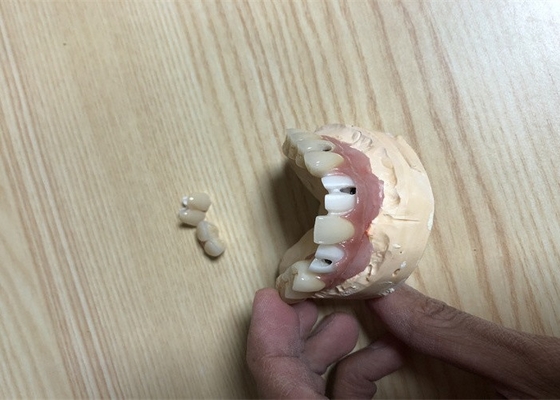 Точный зуб приложений зубного имплантата Biocompatibility имплантирует крону