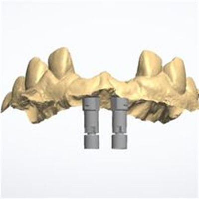 3D model Zirconia crown
