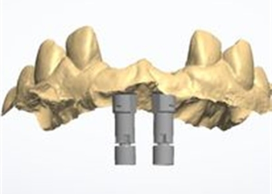 Точное CAD/CAM дизайн циркониевой зубной короны для установки