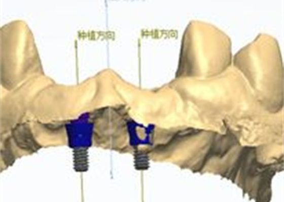 3D-модель Циркониевая корона