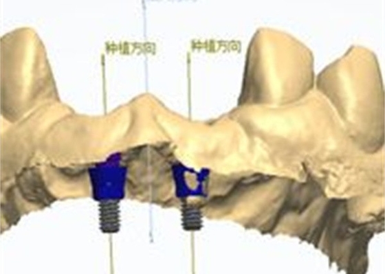 Точное CAD/CAM дизайн циркониевой зубной короны для установки