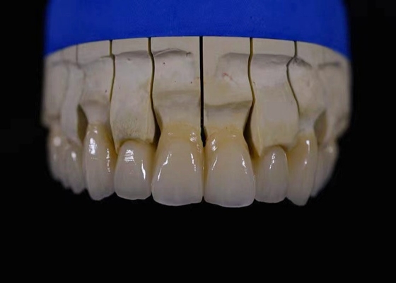 Химическая устойчивость неразводного моста Zirconia восстановления кроны полного Zirconia рта зубоврачебная